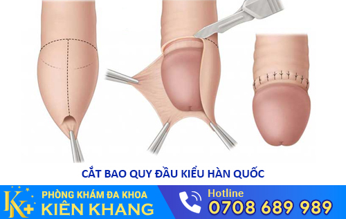 Trị nấm dương vật bằng phương pháp cắt bao quy đầu kiểu Hàn Quốc