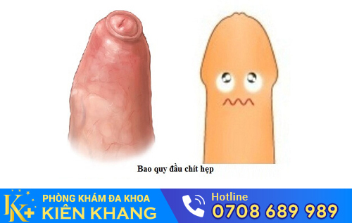 Hình ảnh hẹp bao quy đầu ở người lớn