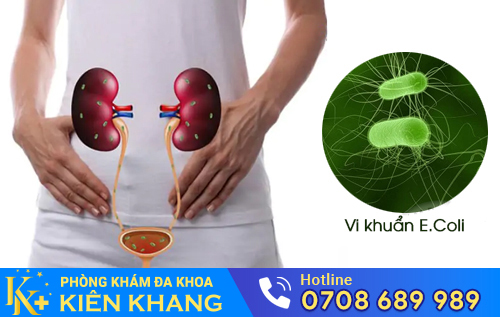 Viêm đường tiết niệu nam do vi khuẩn E.coli gây nên