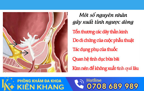 Nguyên nhân gây xuất tinh ngược dòng