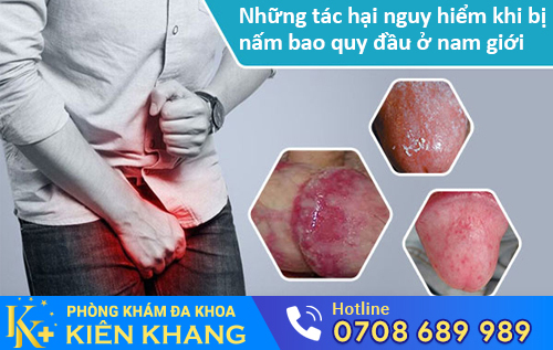 Những tác hại nguy hiểm khi bị nấm bao quy đầu ở nam giới
