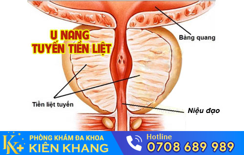U nang tuyến tiền liệt