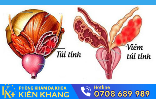 Viêm túi tinh