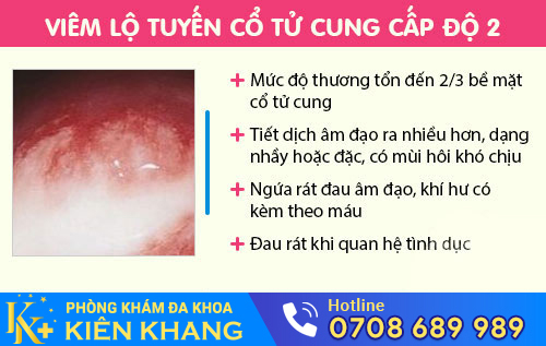 Viêm lộ tuyến cổ tử cung cấp 2