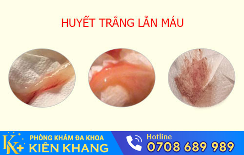 Huyết trắng lẫn máu