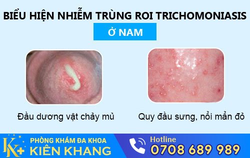 Nhiễm trichomonas ở nam giới