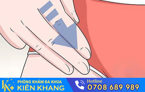 Nổi hạch vùng kín