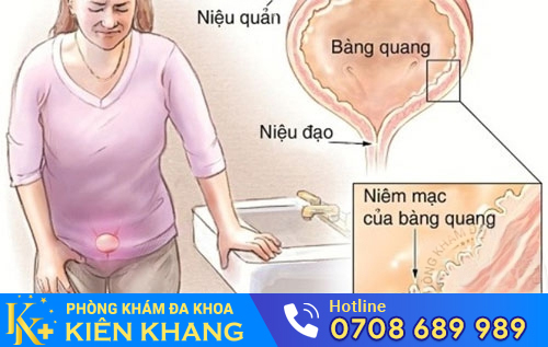 Viêm đường tiết niệu nữ gây ra nhiều biến chứng nguy hiểm