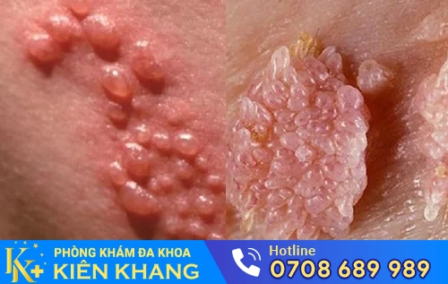 bieu hien benh sui mao ga