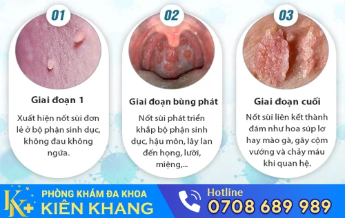 giai doan phat trien benh sui mao ga