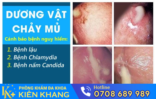 Niệu đạo chảy mủ gây ra nhiều biến chứng nguy hiểm