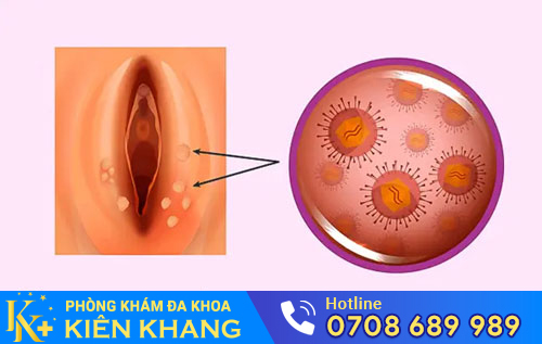nổi mụn ở môi lớn, môi bé âm đạo