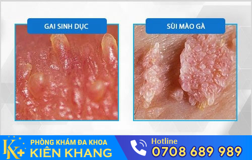 Phân biệt gai sinh dục và sùi mào gà