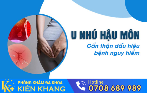 U nhú hậu môn