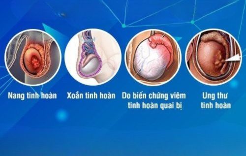 Một số bệnh lý tinh hoàn thường gặp ở nam giới
